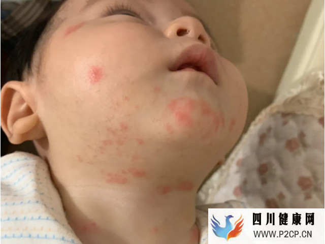 病毒疹常发生人群是婴幼儿和儿童