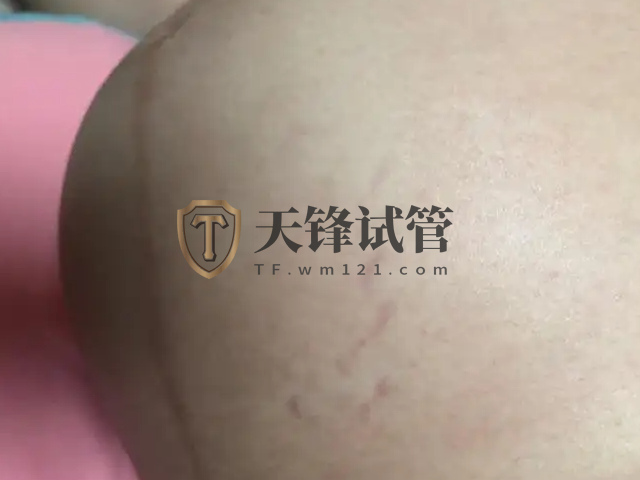 妊娠线看男女方法