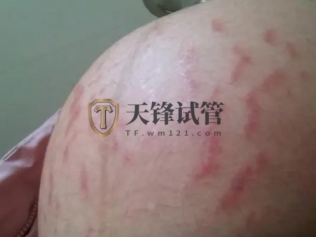 妊娠线看男女不准