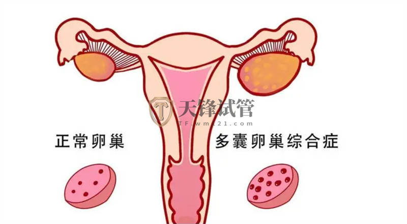 多囊卵巢怀不上孩子怎么办？做试管婴儿能够成功怀上宝宝吗(图1)