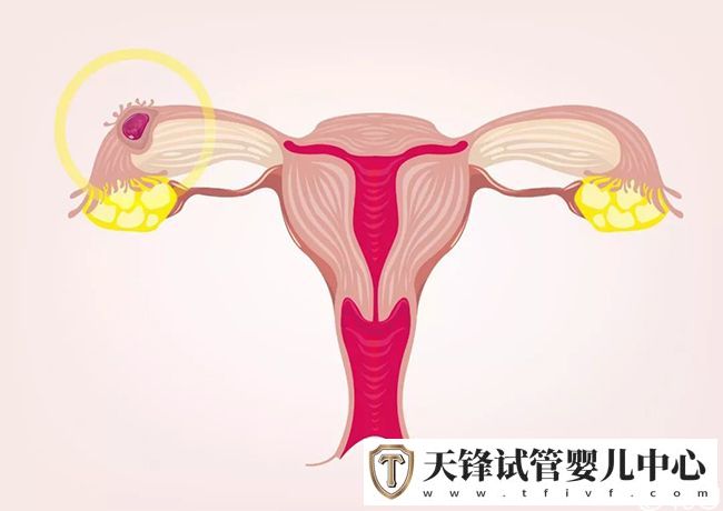 试管婴儿高频问题之输卵管，5个维度的通畅度分析(图2)