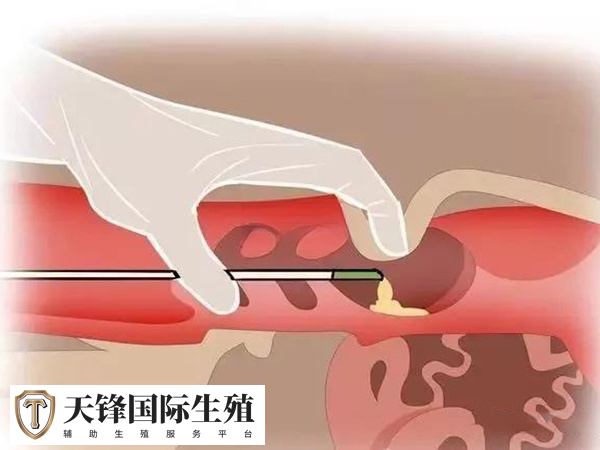 每次人工授精的费用在5000元左右