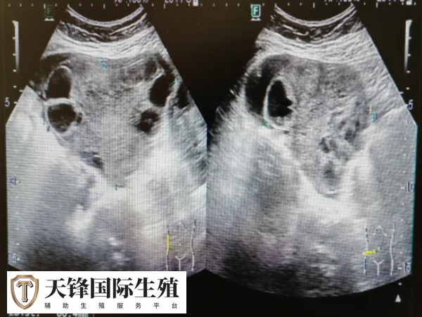 卵巢过度刺激不宜移植鲜胚