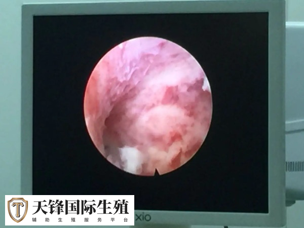 宫腔镜检查能见检查子宫腔及输卵管