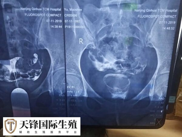 盆腔环境异常要进行冻胚移植